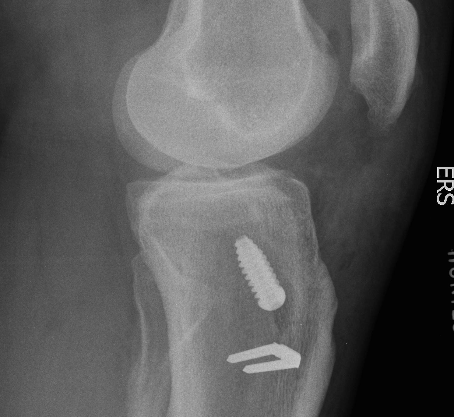 ACL Tibial Tunnel Posterior